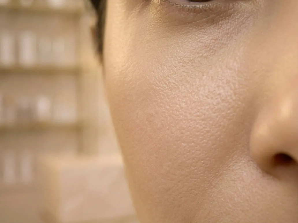 Pores dilatés